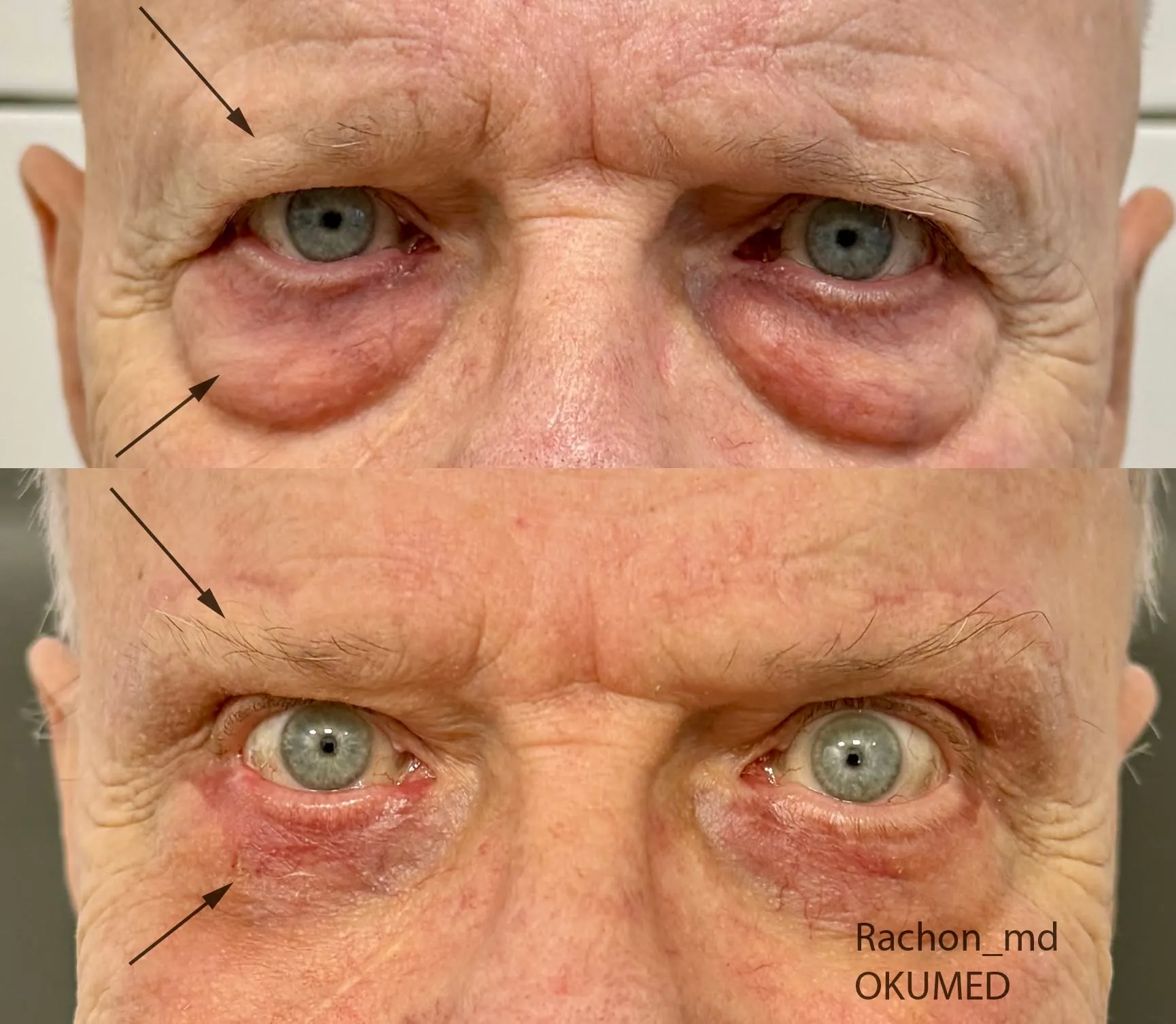 Bezpośredni lifting brwi, plastyka powiek dolnych