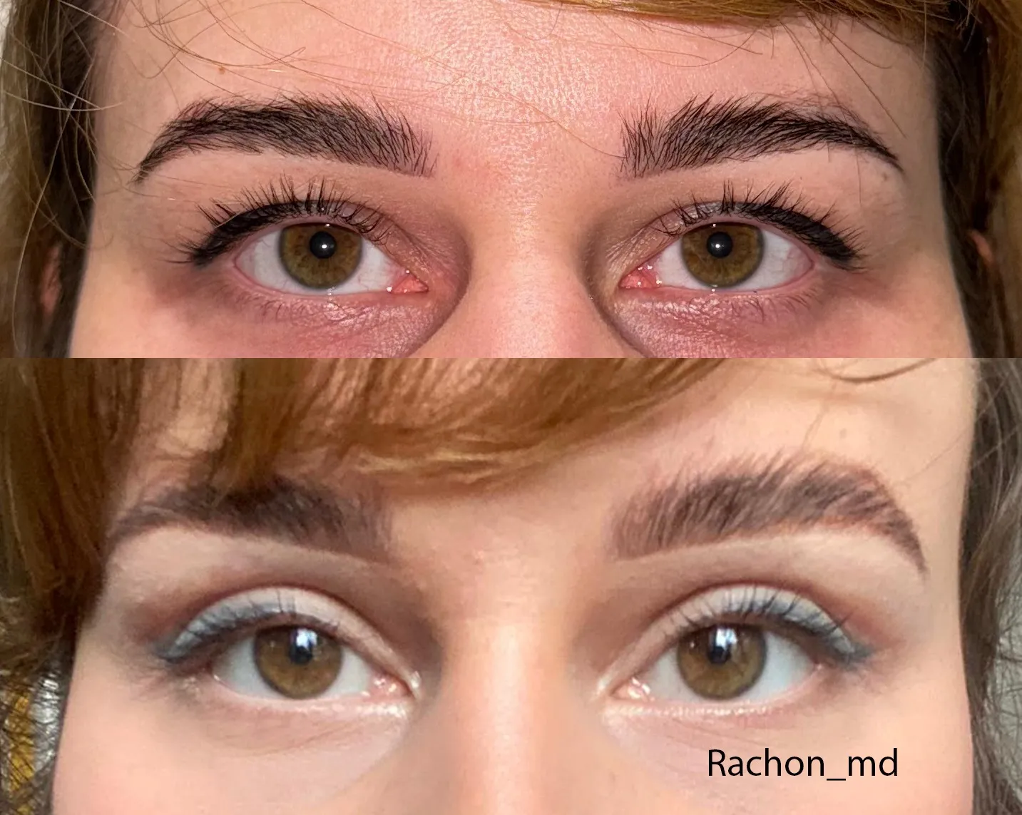 Plastyka powiek górnych